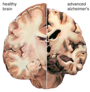 Alzheimer's causes changes in the brain, leading to challenging behaviors. 