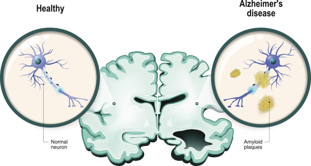 Alzheimer's vaccine trial